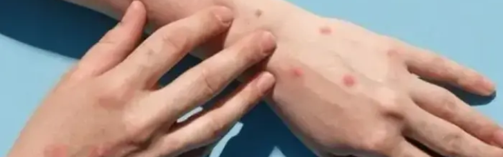 У Підмосковʼї спалах мавпячої віспи