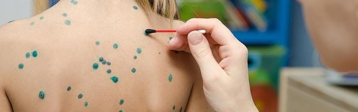 На Франківщині зафіксовано спалах вітрянки у дітей