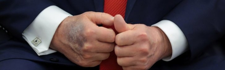 Трамп "засветил" в Давосе синяк на руке: говорит, что из-за стола, и советует налегать на аспирин (ВИДЕО)